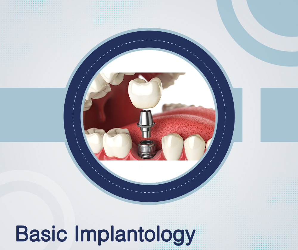 Basic Implant