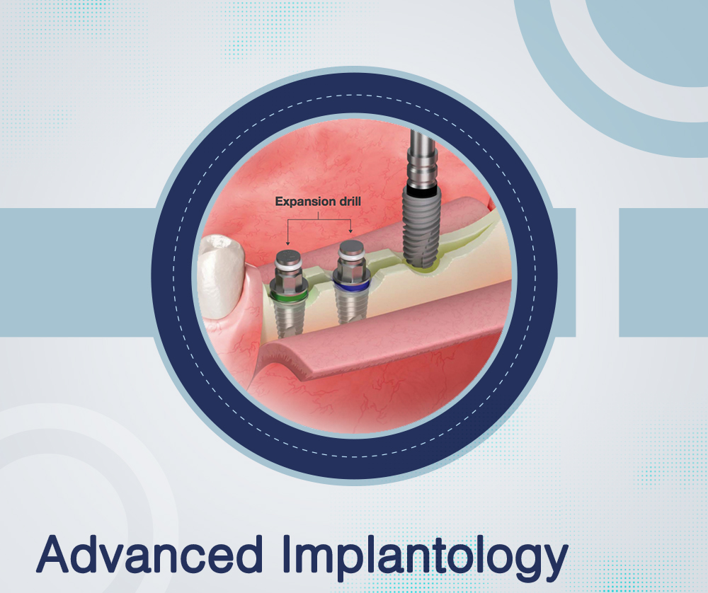 Advanced Implant